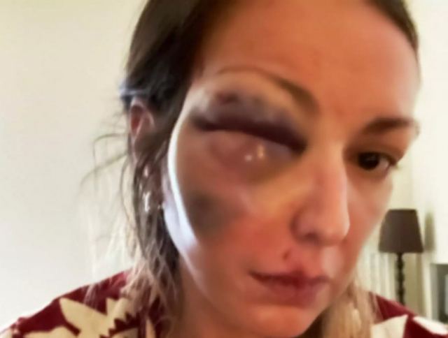 Σοκάρει γνωστή Ελληνίδα food blogger: Έπεσε θύμα κακοποίησης - Δημοσίευσε φωτογραφίες μετά τον ξυλοδαρμό